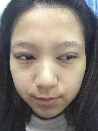 雙眼皮