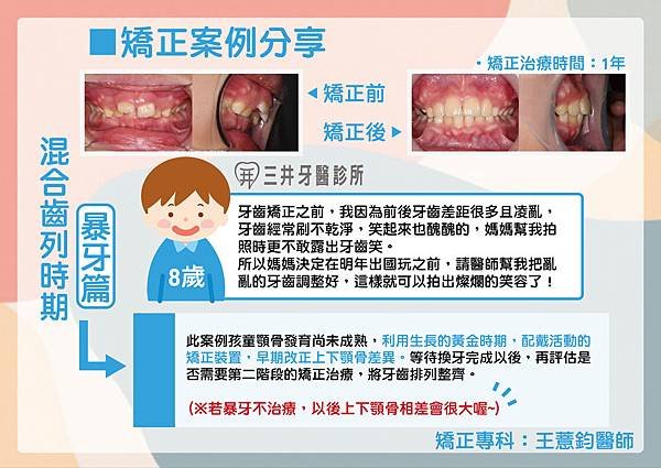 混合齒列-暴牙