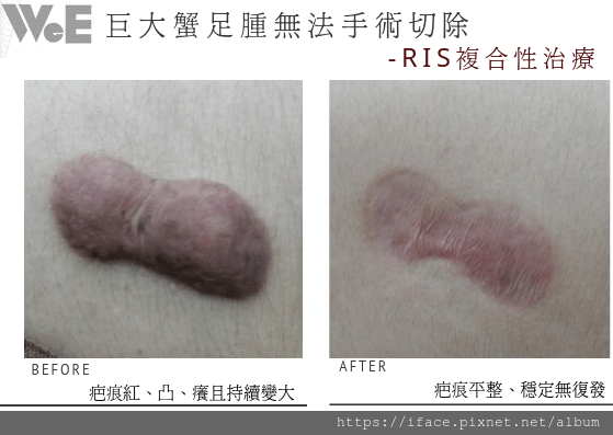 【除疤】無法切除之蟹足腫｜巨大蟹足腫治療｜治療蟹足腫│疤痕疙