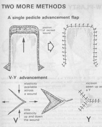 vy and advancement flap[1]