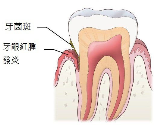 圖一、牙菌斑是造成牙周病主要原因