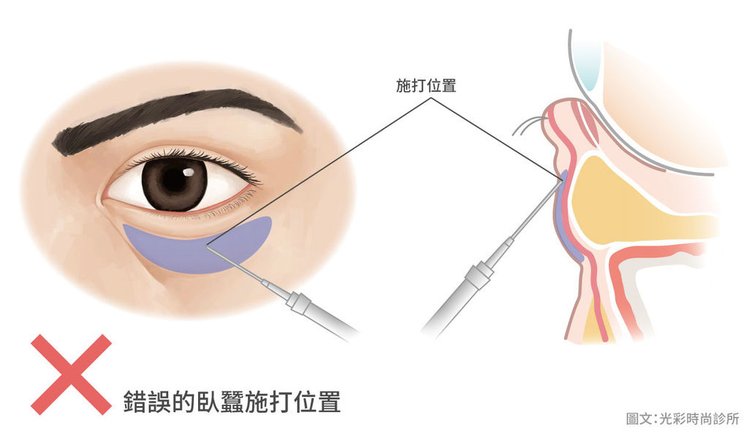 光彩時尚診所玻尿酸郭弘義醫師玻尿酸臥蠶臥蠶比例顏值自然臥蠶東區醫美推薦高鹽植高滿意凝膠式玻尿酸注射醫美微整形06.jpg