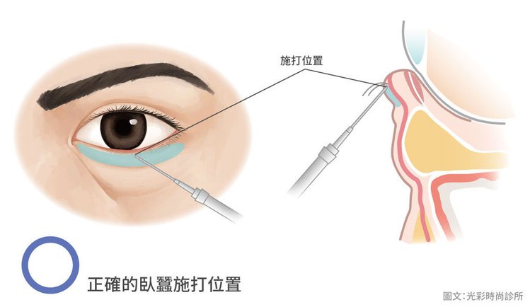 光彩時尚診所玻尿酸郭弘義醫師玻尿酸臥蠶臥蠶比例顏值自然臥蠶東區醫美推薦高鹽植高滿意凝膠式玻尿酸注射醫美微整形07.jpg