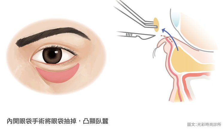 消除下眼袋消除眼袋眼霜消除眼袋的方法消除眼袋的好方法如何自然消除眼袋眼袋成因眼袋手術內開眼臥蠶夠-有眼袋.jpg