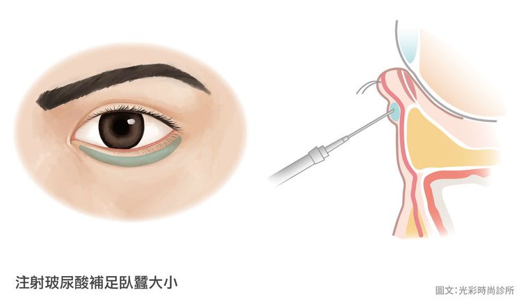 消除下眼袋消除眼袋眼霜消除眼袋的方法消除眼袋的好方法如何自然消除眼袋眼袋成因眼袋手術內開眼.jpg