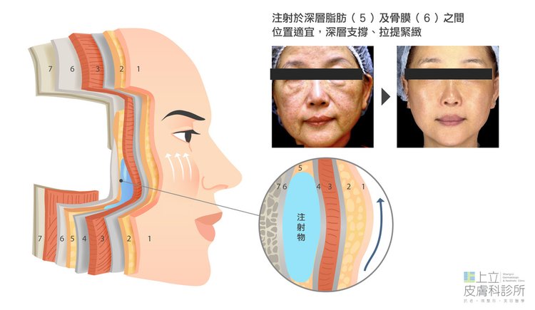 洢蓮絲注射在正確的層次，臉部輪廓明顯收緊、拉提.jpg