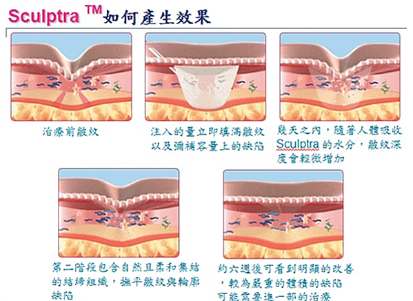 舒顏萃、洢蓮絲、艾麗斯 3種膠原蛋白增生劑大不同