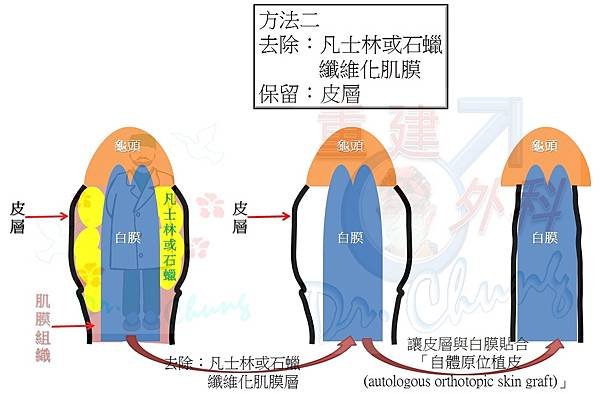 陰莖注射凡士林/石蠟的處理架構(The treatment 