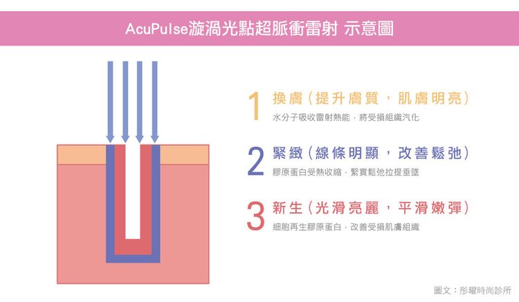 AcuPulse價格AcuPulse副作用AcuPulse痘疤AcuPulse高雄AcuPulse多久打一次AcuPulse術後AcuPulse凹洞AcuPulse保養超脈衝雷射.jpg