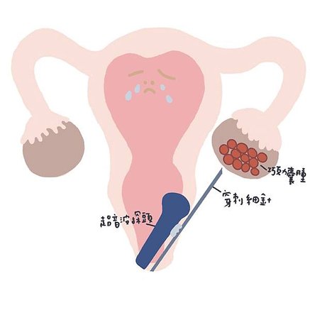 好孕來臨｜(三) 巧克力囊腫抽吸手術｜Fig.1 手術示意圖jpg