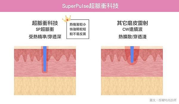 acupulse超脈衝雷射痘疤雷射痘疤治療除凹疤彤曜診所沈育如醫師皮膚專科高雄醫美推薦05.jpg