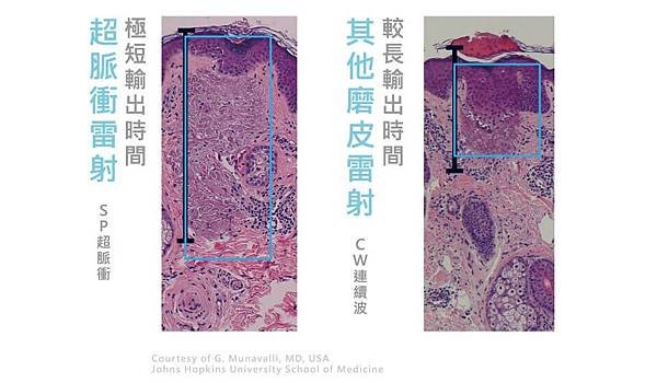 acupulse超脈衝雷射痘疤雷射痘疤治療除凹疤彤曜診所沈育如醫師皮膚專科高雄醫美推薦06.jpg