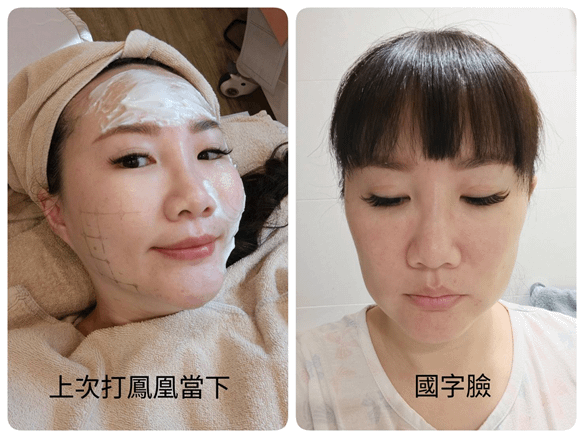 醫美推薦｜索夫波痛嗎？有用嗎？40歲三寶媽打索夫波超詳細全紀