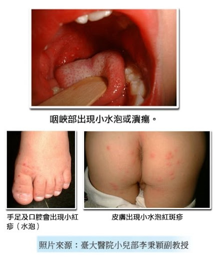 腸病毒宣導含歷年公文