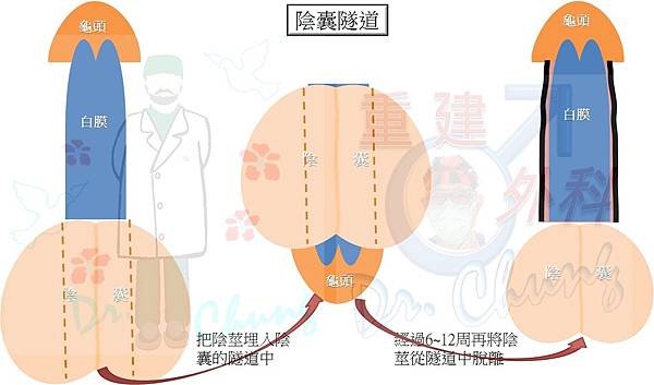 陰莖注射凡士林/石蠟的處理架構(The treatment 