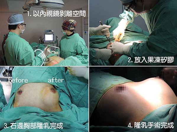 台中隆乳手術、台中自體脂肪隆乳、台中隆乳費用價格、台中水滴型(形)果凍隆乳、台中內視鏡隆乳、台中果凍矽膠豐胸隆乳、台中蜜桃絨隆乳、台中乳暈隆乳、台中豐胸、台中腋下隆乳、台中肚臍隆乳、台中筋膜下隆乳、台中自體移植脂肪隆乳、台中隆乳按摩、台中隆乳術後按摩、台中隆乳價格、台中隆乳價錢、台中隆乳推薦醫師、台中隆乳權威名醫、台中整形外科醫學美容、台中菲仕美診所、台灣隆乳隆胸手術專家，林孟羲院長｜楊學穎醫師｜許永昌醫師｜朱純慧醫師