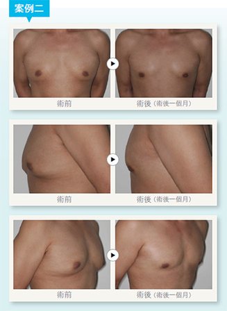 男性女乳症手術3.jpg