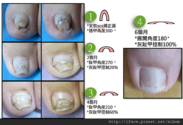 捲甲矯正治療 台北台中新竹