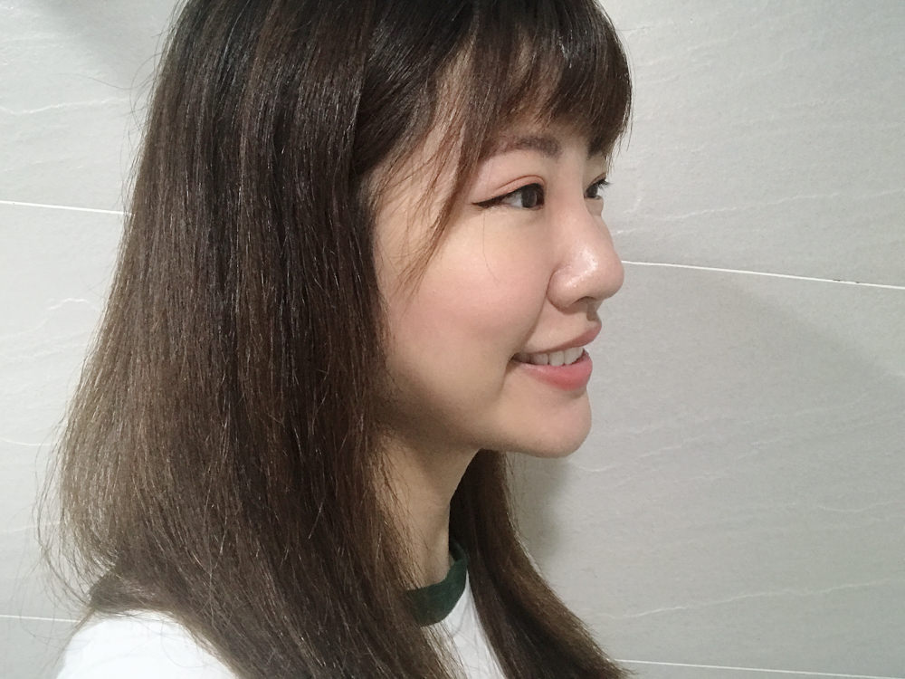 玻尿酸鼻子變寬