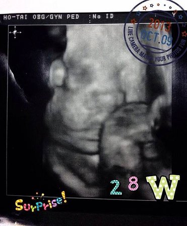 28W-3D超音波
