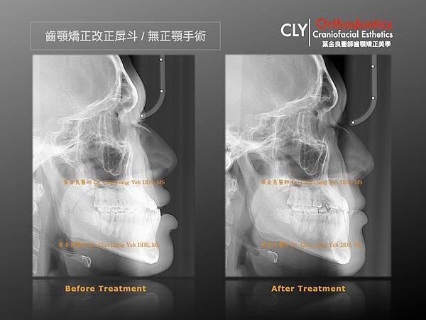 『矯正治療不是解決咬合問題那樣單純，應該是賦予臉部輪廓更深的