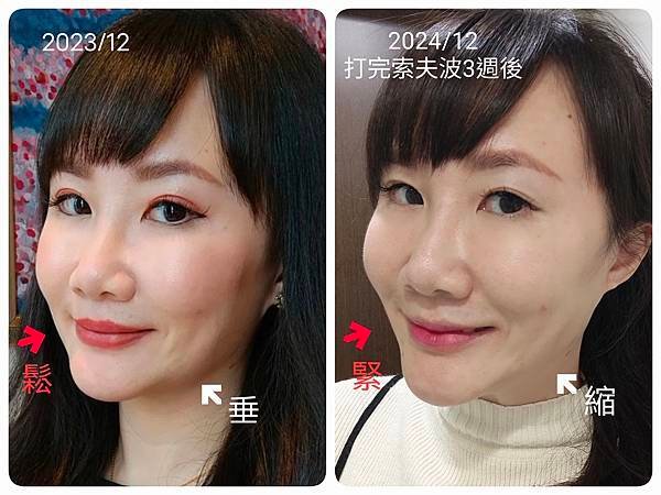 醫美推薦｜索夫波痛嗎？有用嗎？40歲三寶媽打索夫波超詳細全紀