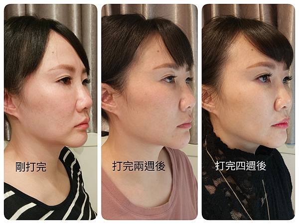 醫美推薦｜索夫波痛嗎？有用嗎？40歲三寶媽打索夫波超詳細全紀