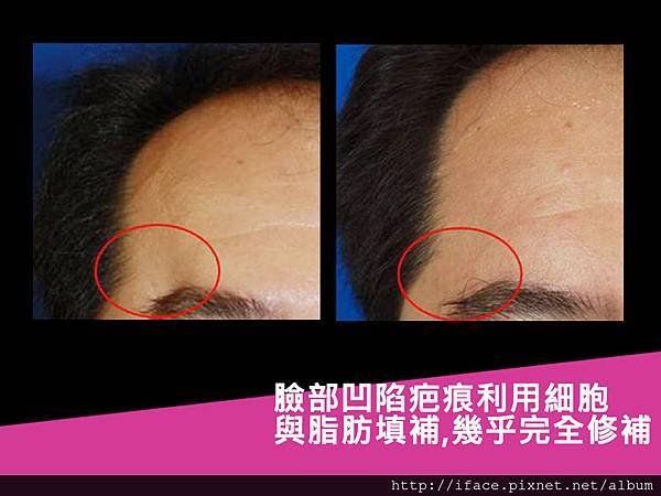 臉部撕裂傷、臉部疤痕 、燙傷治療：『除疤』『修疤』『淡疤』U