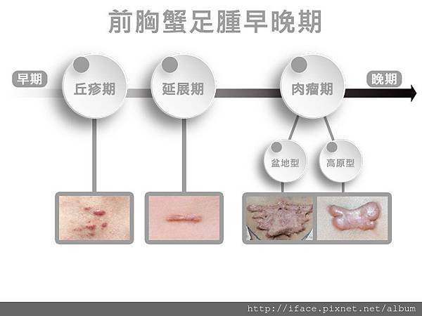 【除疤】無法切除之蟹足腫｜巨大蟹足腫治療｜治療蟹足腫│疤痕疙