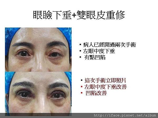 高階顯微手術「雙眼皮疤痕」重修~搶救割壞雙眼皮「眼頭疤痕」「