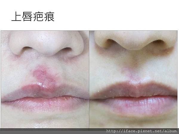 嘴唇凸疤