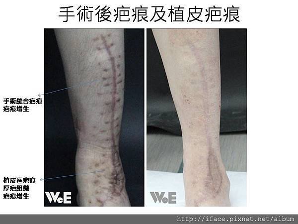車禍疤痕治療