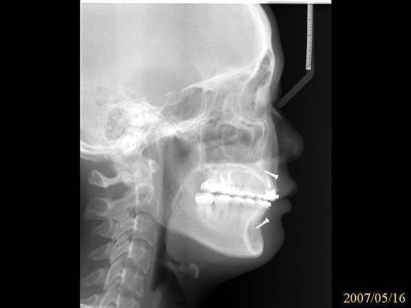 @齒顎矯正每日一說~~0227人中骨釘