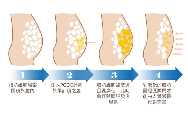 消脂針消脂針按摩消脂針價格消脂針手臂消脂針臉消脂針消腫消脂針成分消脂針費用消脂針效果瘦身減肥瘦小臉冷凍減脂雙下巴嬰兒肥嬰兒肥醫美嬰兒肥瘦臉05.jpg