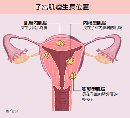 子宮肌瘤.jpg