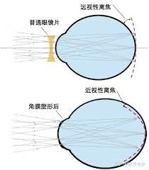 【角膜塑形片 又稱OK鏡，真能減少孩子的近視加深速率？！兒子