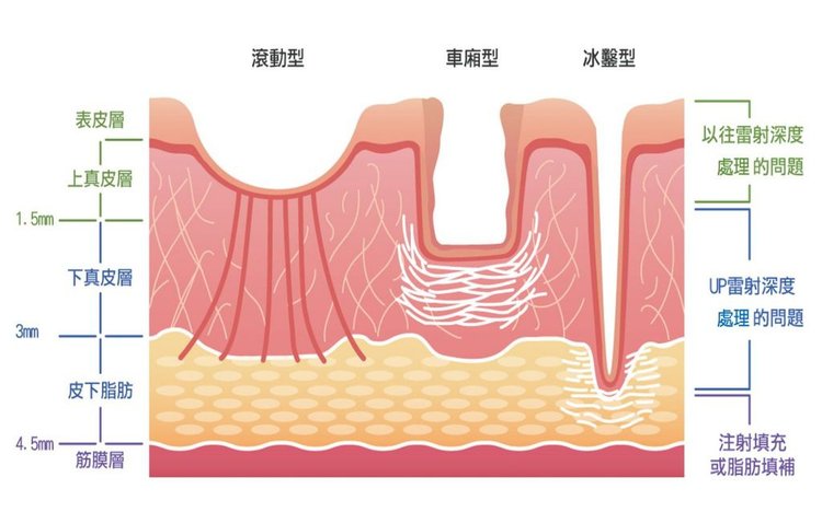 痘疤紅痘疤彩衝光脈衝光M22