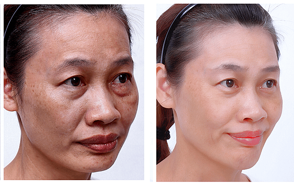 Ellanse-Sculptra-AestheFill-which-better