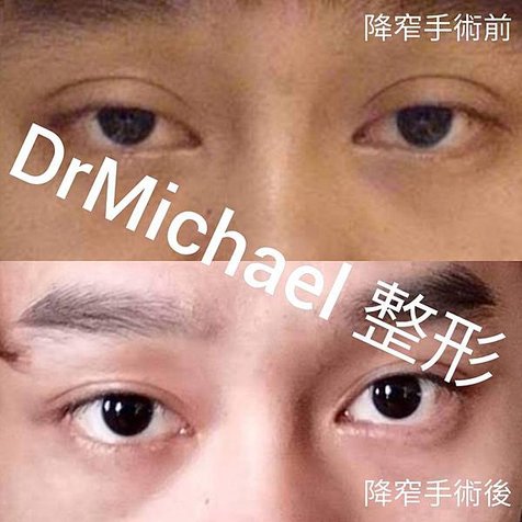 【不去皮（保留眼皮）降窄雙眼皮】雙眼皮過寬？太深？但是眼皮不夠切皮，該怎麽辦？沈筠惇醫師談保留眼皮的降窄雙眼皮