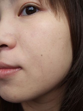 元和雅-無名部落客阿筍元和雅飛梭雷射 案例照12.jpg