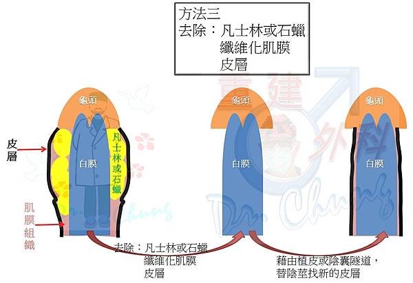 陰莖注射凡士林/石蠟的處理架構(The treatment 