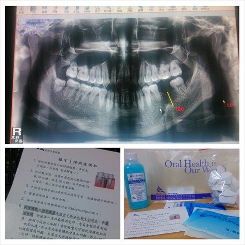 2014.12.26 東群牙醫植牙手術