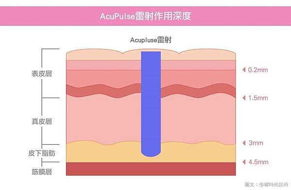 acupulse超脈衝雷射痘疤雷射痘疤治療除凹疤彤曜診所沈育如醫師皮膚專科高雄醫美推薦04.jpg