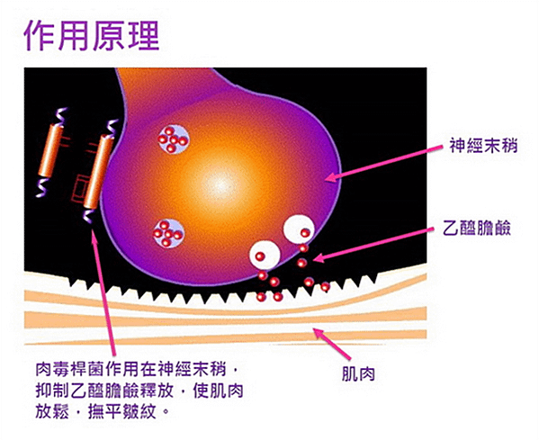 肉毒幫妳消除惱人皺紋  展現自信美