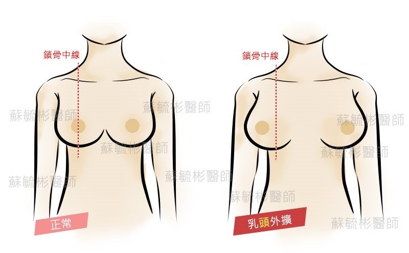 【高雄隆乳】判斷胸部外擴及定義,內視鏡水滴型果凍隆乳手術改善胸型,矯正胸部外擴｜高雄蘇毓彬醫師.jpg