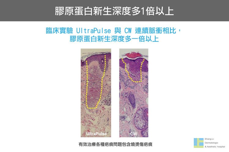 Up雷射ultrapulse汽化雷射雷射效果痘疤凹疤up雷射永和皮膚科林上立醫師上立皮膚科5.jpg