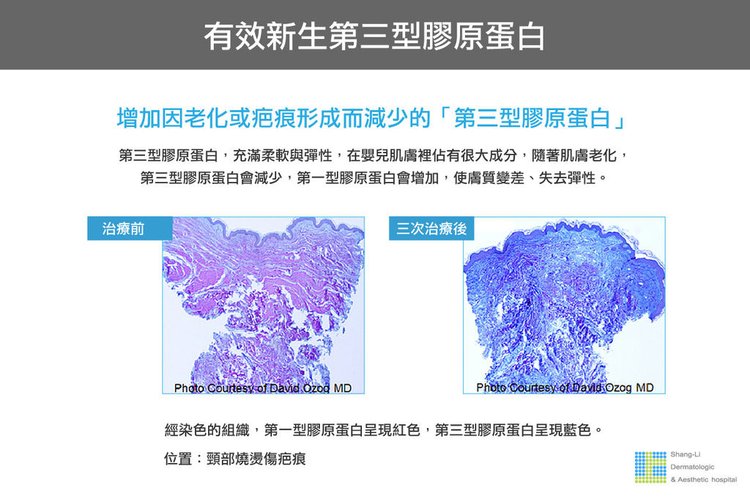 Up雷射ultrapulse汽化雷射雷射效果痘疤凹疤up雷射永和皮膚科林上立醫師上立皮膚科13.jpg