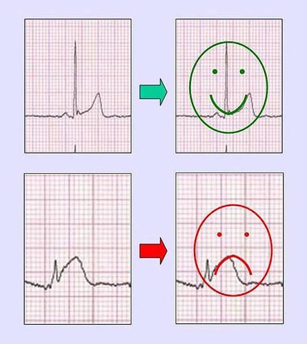 concave_nonconcave_smile_frown.jpg