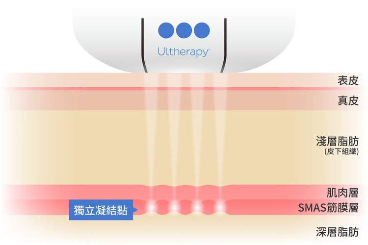 海芙音波拉提臉部拉提雙下巴消除彤曜診所沈育如醫師皮膚專科音波拉皮推薦音波拉皮效果音波拉提術後02.jpg