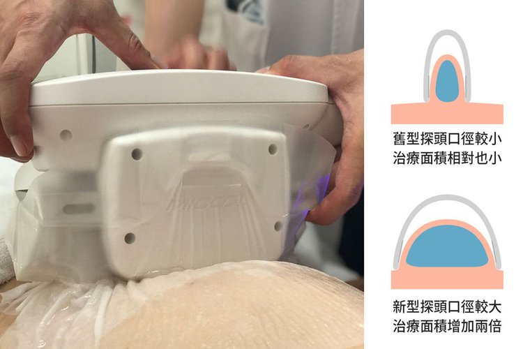 冷凍溶脂冷凍減脂非侵入式體雕抽脂副作用肚子瘦手臂大腿3.jpg